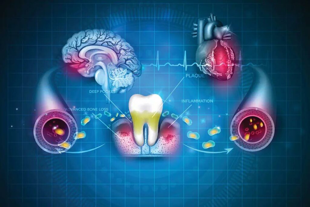 Link Between Periodontal Disease and Overall Health