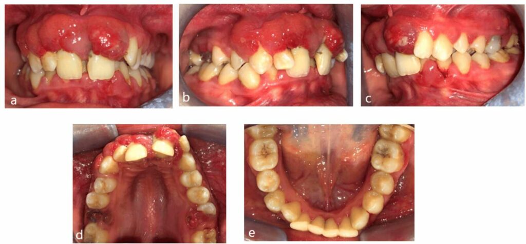 The Silent Challenge: Periodontal Disease in Adolescents