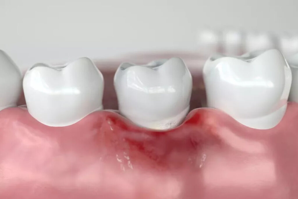 Advanced Treatment Options for Receding Gums