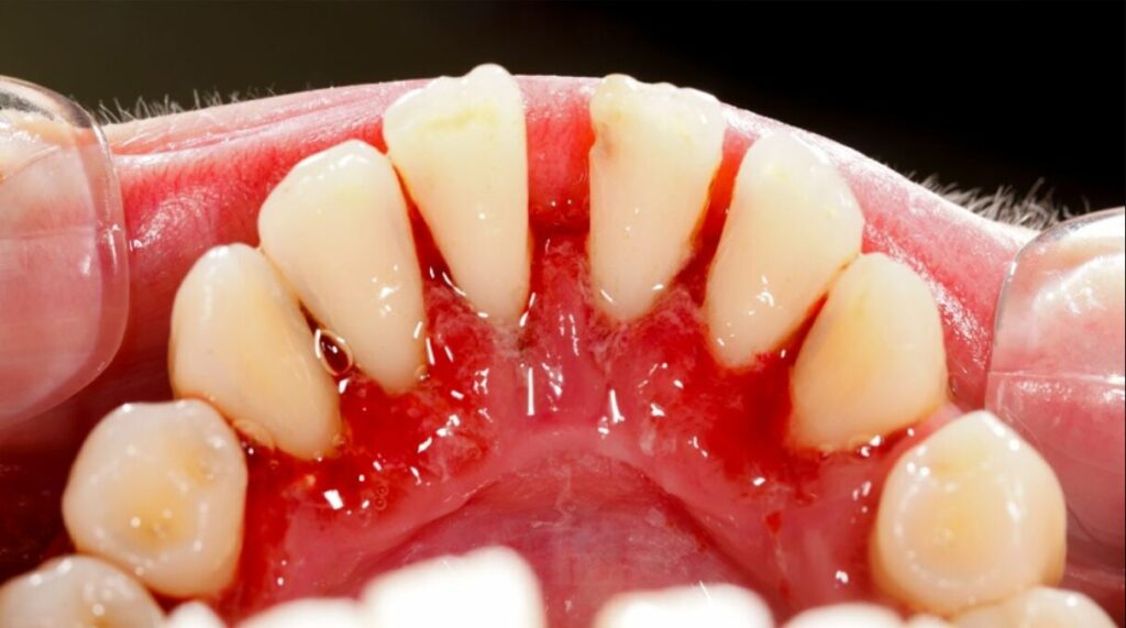 Causes of Receding Gums and Gingivitis