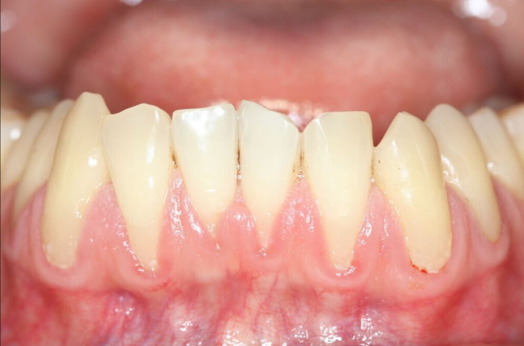 Can Receding Gums Grow Back On Their Own?