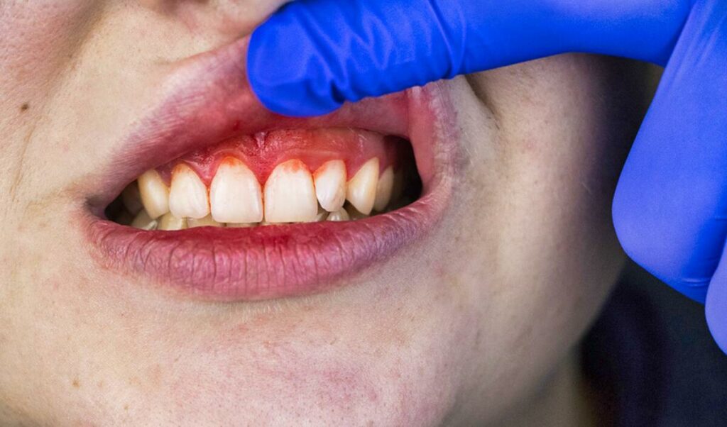 Understanding Gum Disease and Its Causes