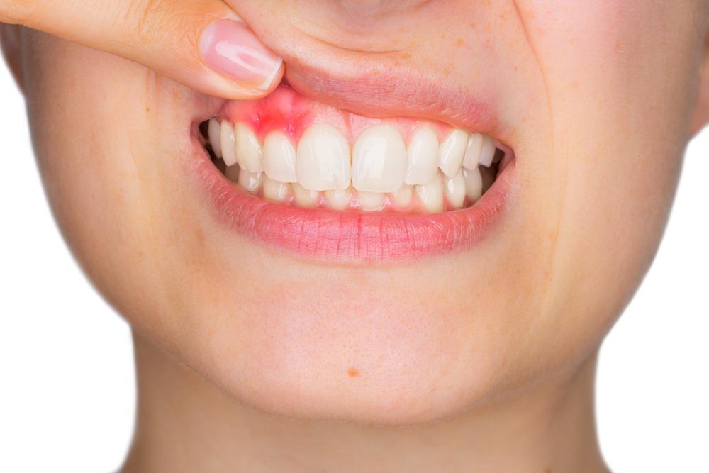 Healing Receding Gums