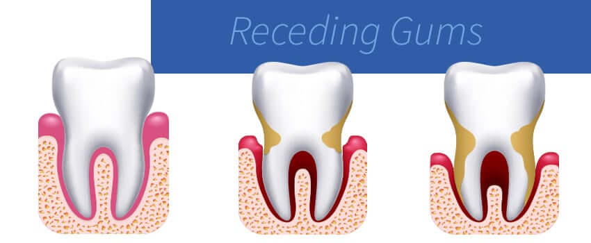 How to Stop Receding Gums