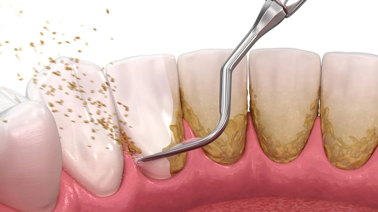 Remove Tartar From Teeth Without Dentist Home Remedies