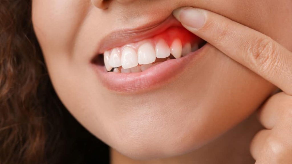 Healing Receding Gums Without Surgery