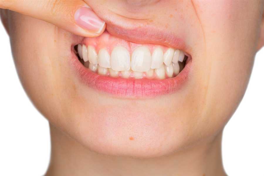 Heal Gums Naturally