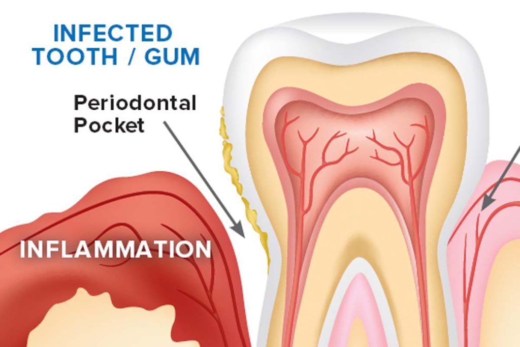  reverse receding gums