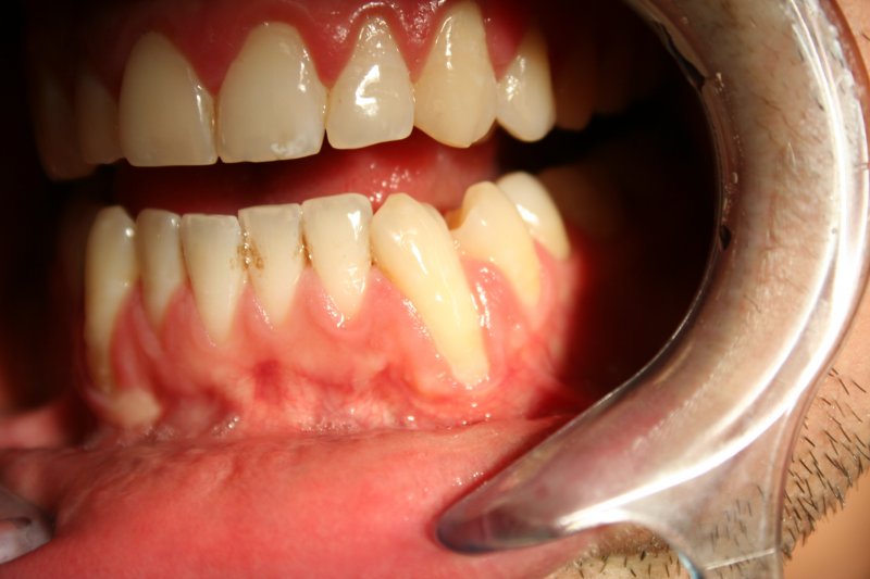 How To Heal Gums Naturally