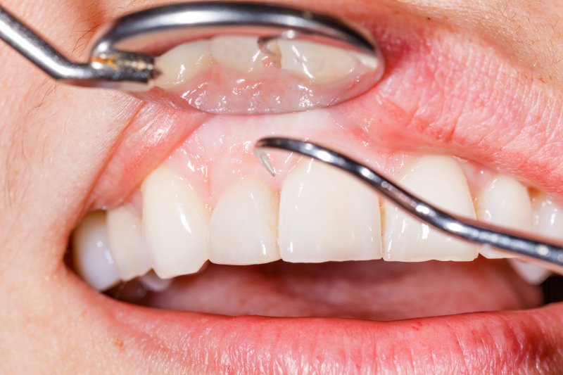 Restoring Gum Health Naturally