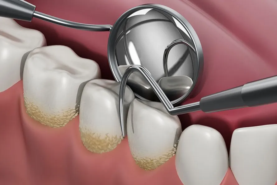 Restoring Gum Loss