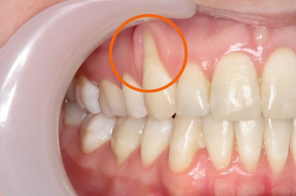 Understanding Gum Recession and Its Causes