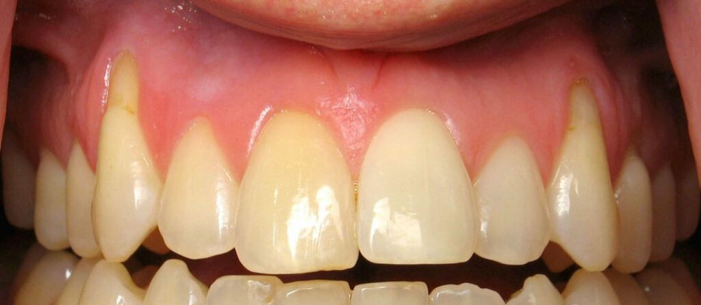 Gum Disease Receding Gums Treatment